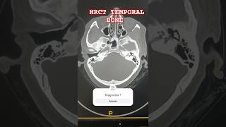 HRCT TEMPORAL BONE  TM JOINT  MASTOID  EAR 👂 radiology ctscan ear hemantkushwah3453 [upl. by Komara]