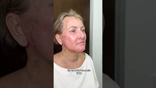 Full Facial Rejuvenation 7 Days After Surgery plasticsurgery [upl. by Rois]