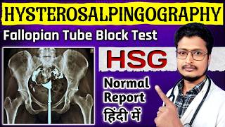 HSG Report Kaise Dekhe  HSG Test Painful Or Not In Hindi  HSG Test Kya Hota Hai  HSG Test Video [upl. by Lemrahc694]