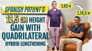 SPANISH PATIENT’S 115 CM HEIGHT GAIN WITH QUADRILATERAL HYBRID LENGTHENING [upl. by Nednarb]