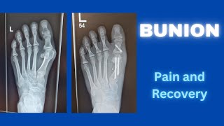 Minimally Invasive Bunion Surgery  Pain and Recovery [upl. by Droffats]