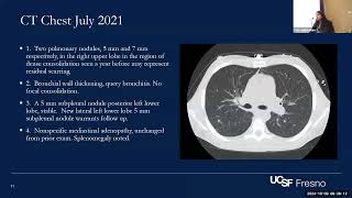 Central Valley Chronicles Challenging Coccidiomycosis Cases in PWH [upl. by Schrader737]