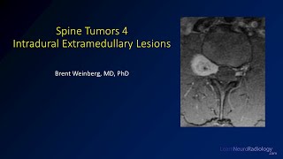 Spine tumors 4 – Intradural Extramedullary Lesions [upl. by Melisse787]