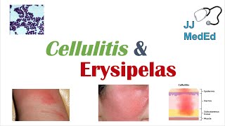 Cellulitis vs Erysipelas  Bacterial Causes Risk Factors Signs and Symptoms Treatment [upl. by Htebasil]