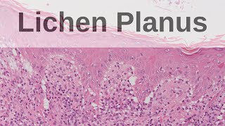 Lichen Planus  Pathology mini tutorial [upl. by Kokoruda787]