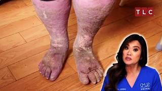 Sandra’s Fight Between Life and Death  Dr Pimple Popper  TLC [upl. by Milde764]