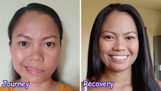 My Bells Palsy journey to recovery  Facial Paralysis [upl. by Jary]