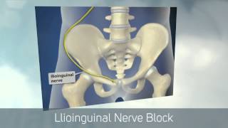 Dr Kornick Riverside Spine Jacksonville 904 3891010 Ilioinguinal Nerve Block [upl. by Ellicott99]