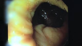 Video of a Colonoscopy [upl. by Octave550]