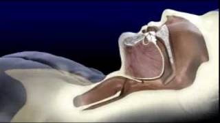 Sleep Apnea Explained By ORA Oral Surgery Sleep Disorder amp Implant Studio [upl. by Nyleaj]