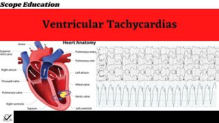 Identifying the Different Types of Ventricular Tachycardias [upl. by Niamert]