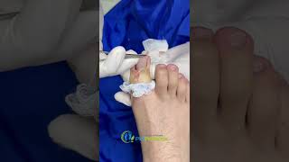 Solución definitiva para uñas encarnadas podologo nails satisfying ingrowntoenail [upl. by Fennelly]