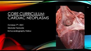 Echocardiography Assessment of Cardiac Masses amp Neoplasms [upl. by Horace4]