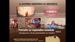 Provisoire sur implantation immédiate quotTechnique de la clé de positionnement du transfertquotvol5 [upl. by Garek]