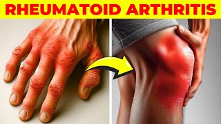 Arthritis  Symptoms Causes Types Treatment amp Prevention [upl. by Nrubua287]