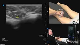 Ultrasound Evaluation of the Posterior Knee [upl. by Foss]