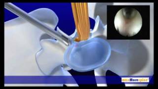 maxMorespine endoscopic animation [upl. by Ricoriki]