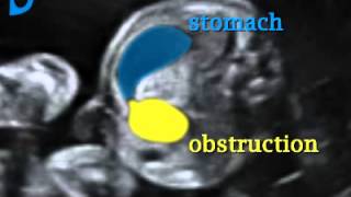 Fetal Medicine Foundation  Duodenal stenosis [upl. by Alolomo]