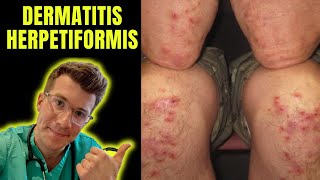 Dermatitis Herpetiformis rash seen in Coeliac Disease aka gluten intolerance explained [upl. by Ase]