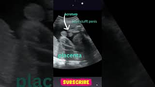 Ultrasound Showing Baby Boy 👶  Gender Reveal shorts [upl. by Ardekahs]