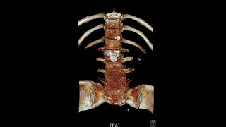 L45 spondylolytic spondylolisthesis [upl. by Ekram]