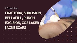 A Patient StoryFRACTORA SUBCISION BELLAFILL PUNCH EXCISION CO2 LASERACNE SCARS Dr Jason Emer [upl. by Kegan]