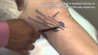 Pes Anserine Bursitis Injection [upl. by Sternlight]