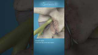 What is Endoscopic Lumbar Foraminotomy Shorts Atlantic Spine Center [upl. by Assillim]