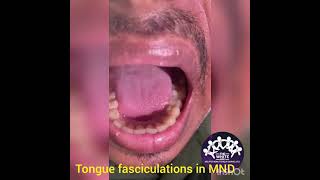 TONGUE FASCICULATIONS [upl. by Einahpit]