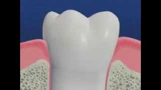 Periodontal Disease amp Treatment [upl. by Drice882]