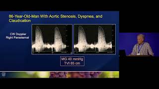 Severe Aortic Stenosis [upl. by Heinrich]