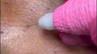 DPN Dermatosis Papulosa Nigra Removal [upl. by Nahallac]