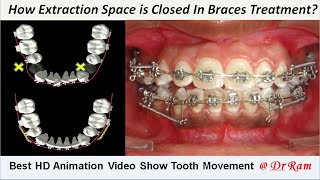 How Extracted Premolars Space is Closed by Braces Best Animation to Know Sliding Mechanics Dr Ram [upl. by Kallick]