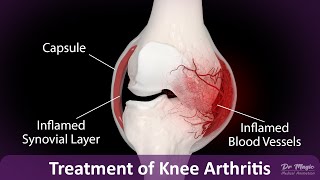 Arthritis Knee Embolization Procedure [upl. by Kristopher727]