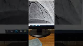 Coronary artery stenting drawing cardio angiogram animation [upl. by Wolff18]