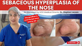 DERMATOLOGIST EXPLAINS HOW TO TREAT NOSE BUMPS DUE TO SEBACEOUS HYPERPLASIA [upl. by Anert81]