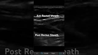 RECTUS SHEATH BLOCK IN LONG AXIS [upl. by Arlon288]