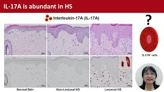 IL17A mast cells in HS CB Chu et al [upl. by Olnton]