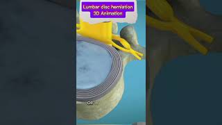 Lumbar Disc Herniation Causes Symptoms amp Treatment  Back Pain Reliefbackpain herniateddisc [upl. by Armond]