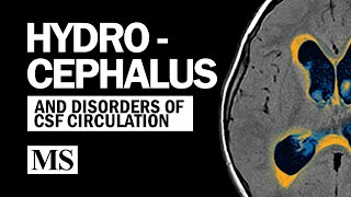 Hydrocephalus And the Disorders of CSF Circulation [upl. by Airrehs]