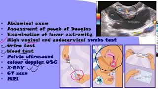 Puerperal sepsis part 2 NGMedicals [upl. by Fiske50]