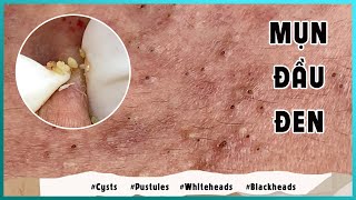 Big Cystic Acne Blackheads Extraction Blackheads amp Milia Whiteheads Removal Pimple Popping [upl. by Ahsial]