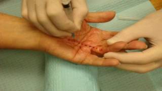 Needle Fasciotomy  Needle Aponeurotomy for Dupuytrens Contracture [upl. by Rebbecca]