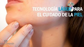 Tecnología láser para quitar manchas en la piel [upl. by Oliy]