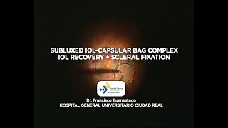 Subluxed IOLcapsular bag complex [upl. by Sheets]