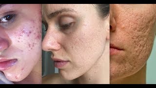 Types Of Acne Scars [upl. by Anujra]