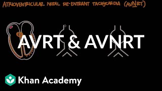 Atrioventricular reentrant tachycardia AVRT amp AV nodal reentrant tachycardia AVNRT [upl. by Zilada]