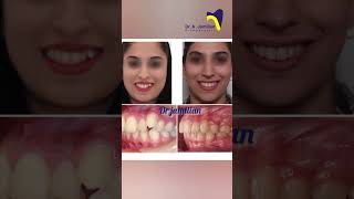 Miracle of Orthodontics Pre and Post orthodontic orthodontics orthodontist before after brace [upl. by Guthrie]