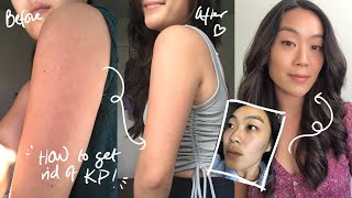 HOW I CLEARED MY KP KERATOSIS PILARIS amp ACNE  Before amp After [upl. by Ellohcin405]