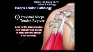 Biceps Tendon amp SLAP Lesion Radiology  Everything You Need To Know  Dr Nabil Ebraheim [upl. by Mercola]